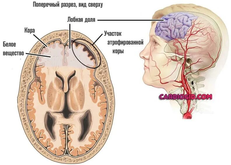 Атрофические изменения коры головного мозга. Атрофические процессы головного мозга. Корковые атрофические изменения вещества головного мозга.. Корковые изменения головного мозга