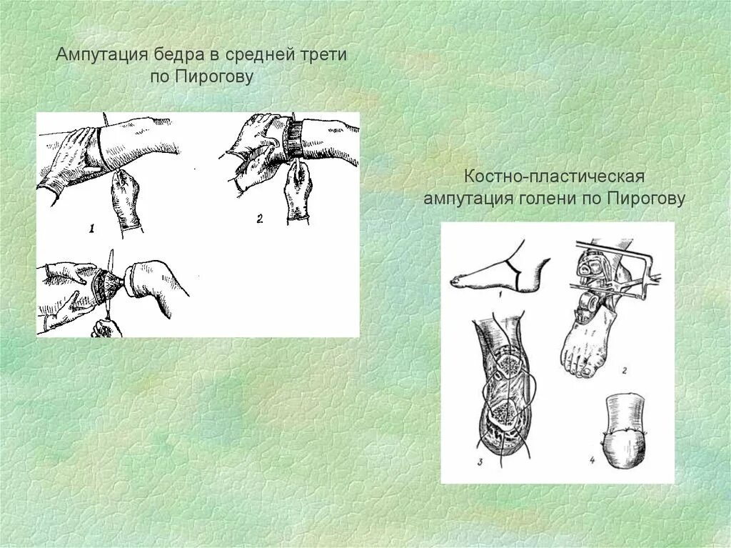 Костно пластическая ампутация по Пирогову. Костно пластическая ампутация голени по Пирогову. Костно пластическая ампутация бедра. Костно-пластическая ампутация голени по н.и. Пирогову.