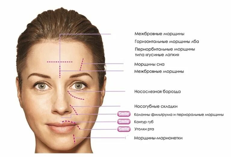 Сколько между бровями. Морщинки на лице название. Ботокс схема введения в лицо. Схема морщин на лице.