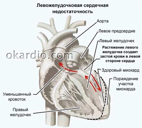 Острая сердечная недостаточность левожелудочковая симптомы. Хроническая левожелудочковая сердечная недостаточность симптомы. Мышечное строение сердца. Нижняя полая вена анатомия сердца. Отёк лёгкого с недостаточностью левого желудочка причина.