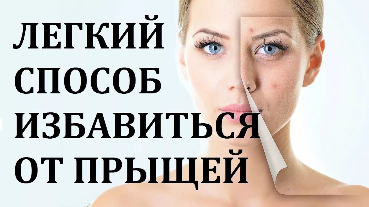 Как раз и навсегда избавиться от прыщей. Какизбавится от прыщей. как избавиться от прыщей раз и навсегда. как избавиться от прыщей на лице навсегда. как избавиться от прыщей на лице.