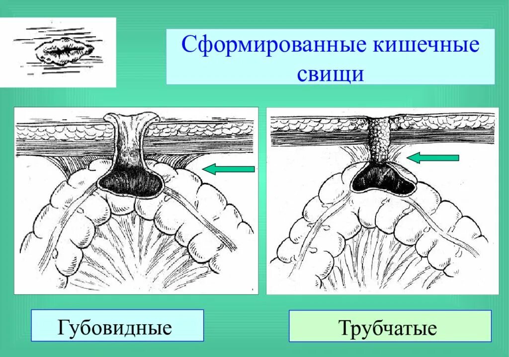 Кишечный свищ. Кишечный свищ