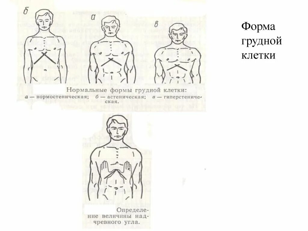 Грудная клетка у ребенка норма. Нормостенический Тип грудной клетки. Формы грудной клетки в норме и патологии у детей. Нормостеническая форма грудной клетки. Конституциональные формы грудной клетки.