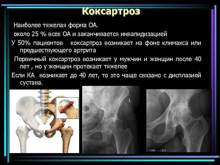 Коксартроз к какому врачу обратиться. Коксартроз тазобедренного сустава степени. Коксартроз тазобедренного рентген степени. Коксартроз 1 степени рентген. Степени коксартроза тазобедренного сустава.