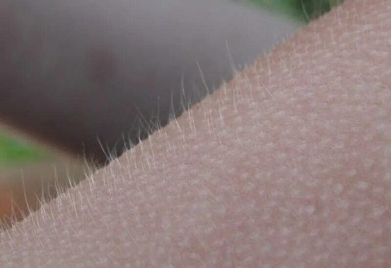 гусиная кожа озноб. гусиная кожа фолликулярный. мурашки по коже гусиная кожа ужас. фолликулярный гиперкератоз кожи. гусиная кожа озноб.