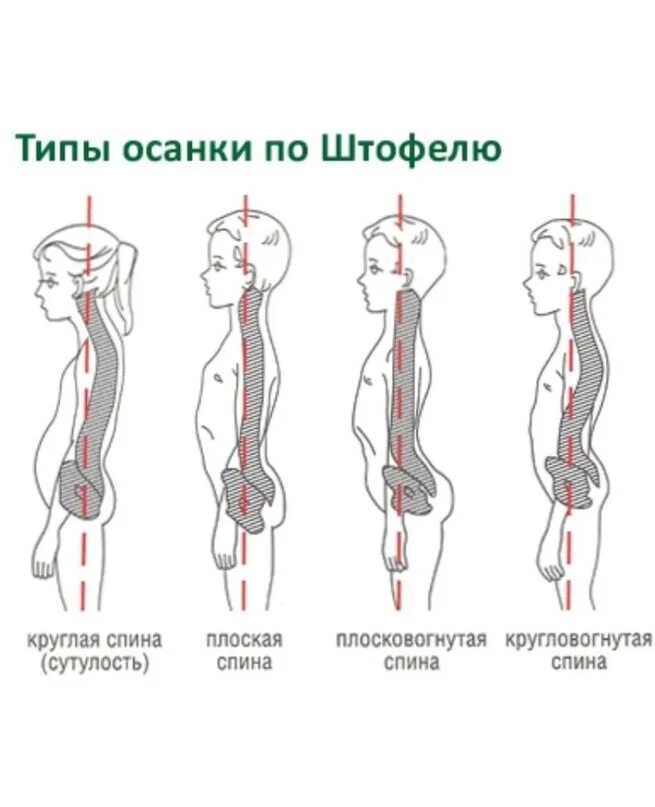 Вогнуто круглая спина. Округло вогнутая спина. Вогнуто круглая спина. Сколиоз кифоз лордоз шейного отдела. Вогнуто плоская спина.