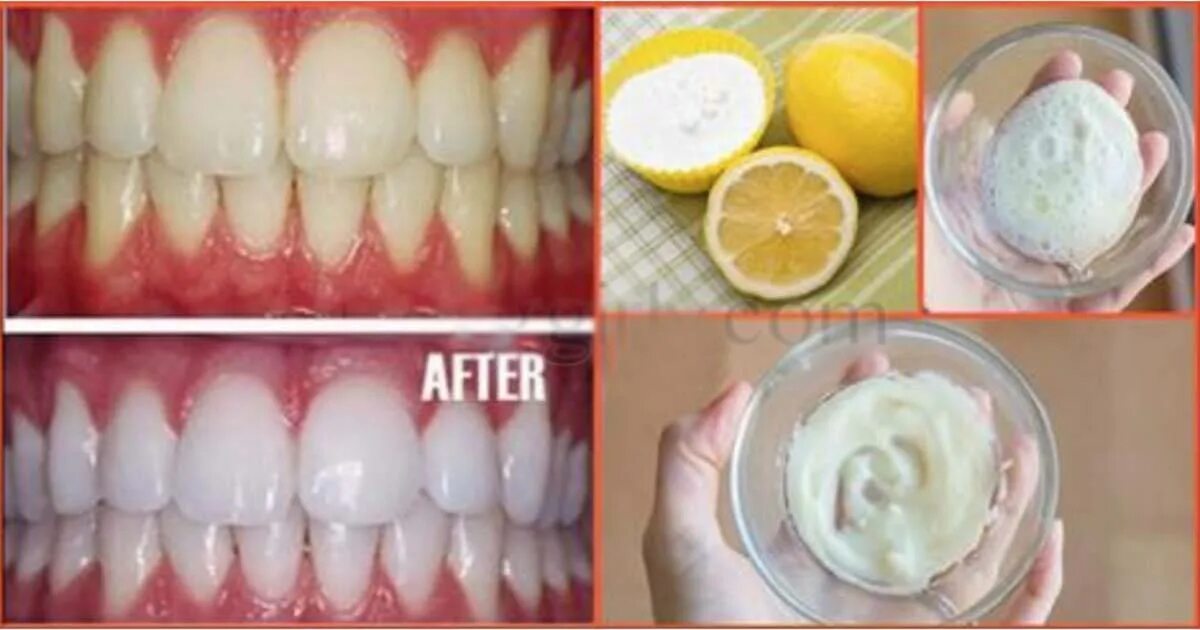 Зуб отбеливание пить. Отбеливание зубов. Зубы окрасились после отбеливания. Зубы до и после отбеливания.