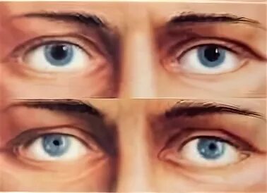 зрачки мужчины расширяются. травматический мидриаз глаза.