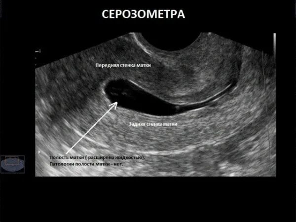 Полип эндометрия в матке на УЗИ. Серозометра в постменопаузе на УЗИ. Серозометра эндометрия.