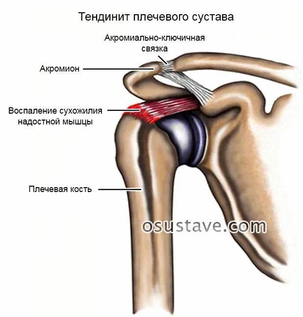 Болит плечо при поднятии. Тендопатия сухожилия надостной мышцы. Тендинит надостной мышцы плечевого сустава. Тендинит сухожилия плеча. Кальцинирующий тендинит сухожилия надостной мышцы.