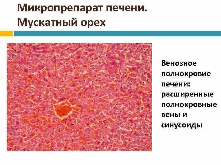 Венозное полнокровие печени мускатная печень микропрепарат. Венозное полнокровие печени микропрепарат. Хроническое венозное полнокровие микропрепарат. Мускатный цирроз печени микропрепарат. Печень микропрепарат описание