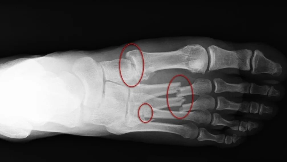 Перелом 3 плюсневой кости. Перелом плюсневой кости стопы рентген. Перелом кости стопы рентген. Рентген перелома 5 плюсневой кости.