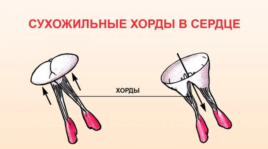 Наличие хорды у человека. Дополнительная хорда в сердце. Сухожильные хорды сердца.