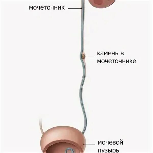 катетер стент. удаление стента у женщин. стент мочеточниковый в почке. стентирование вмп мочеточника. уретроскопия камни в мочеточнике.