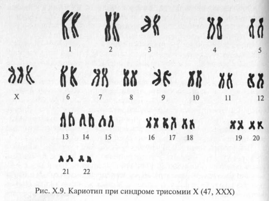 Синдром полисомии по y-хромосоме кариотип. Синдром трисомии по х-хромосоме. Синдром трисомии y хромосомы. Синдром трисомии по х-хромосоме кариотип.