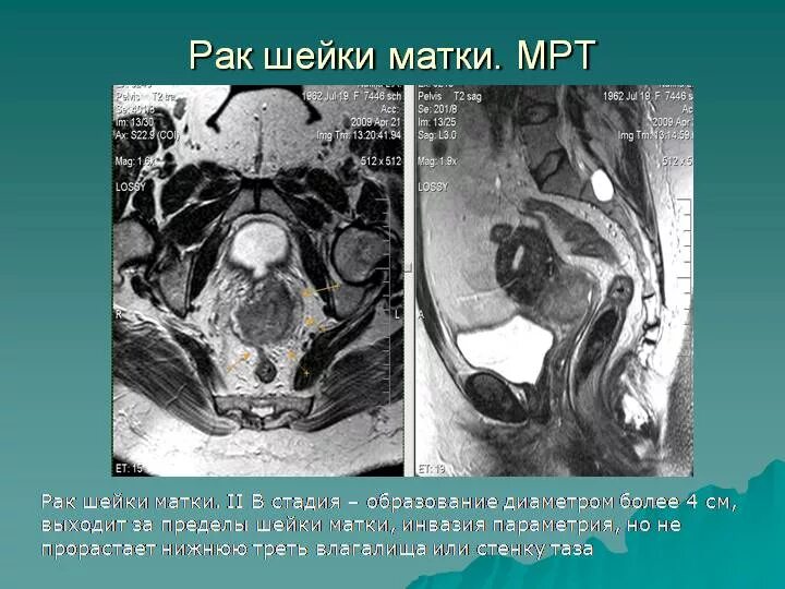 Мрт малого таза Сергея Березина. Опухоли шейки матки на мрт. Мрт анатомия малого таза. MRT monogo toza. Инвазивный рак шейки