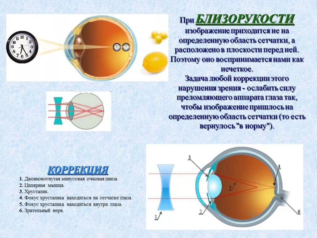 Близорукость рисунок. Изображение при близорукости. Миопия простая что такое. Зрение при близорукости. Перед сетчаткой расположена