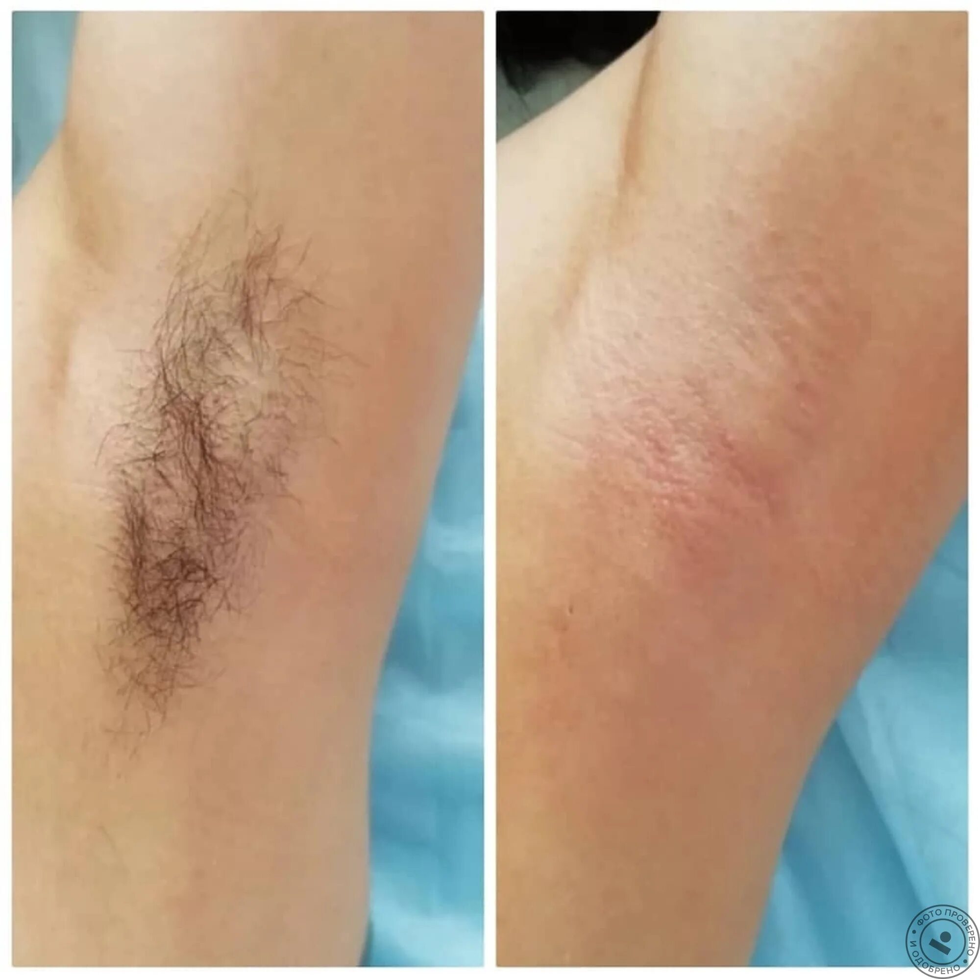 Лазерная эпиляция бедра. Эпиляция под. Лазерная эпиляция бикини до и после. Восковая депиляция. Элос эпиляция до и после.
