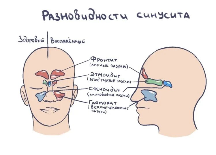 Воспаленные пазухи носа. Болит нос и отдает в голову