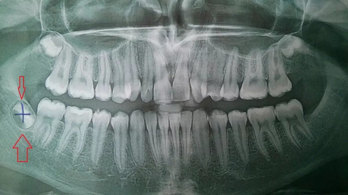 Ретинированный зуб мудрости рентген. Ретинированный дистопированный зуб. Зуб 8 корень
