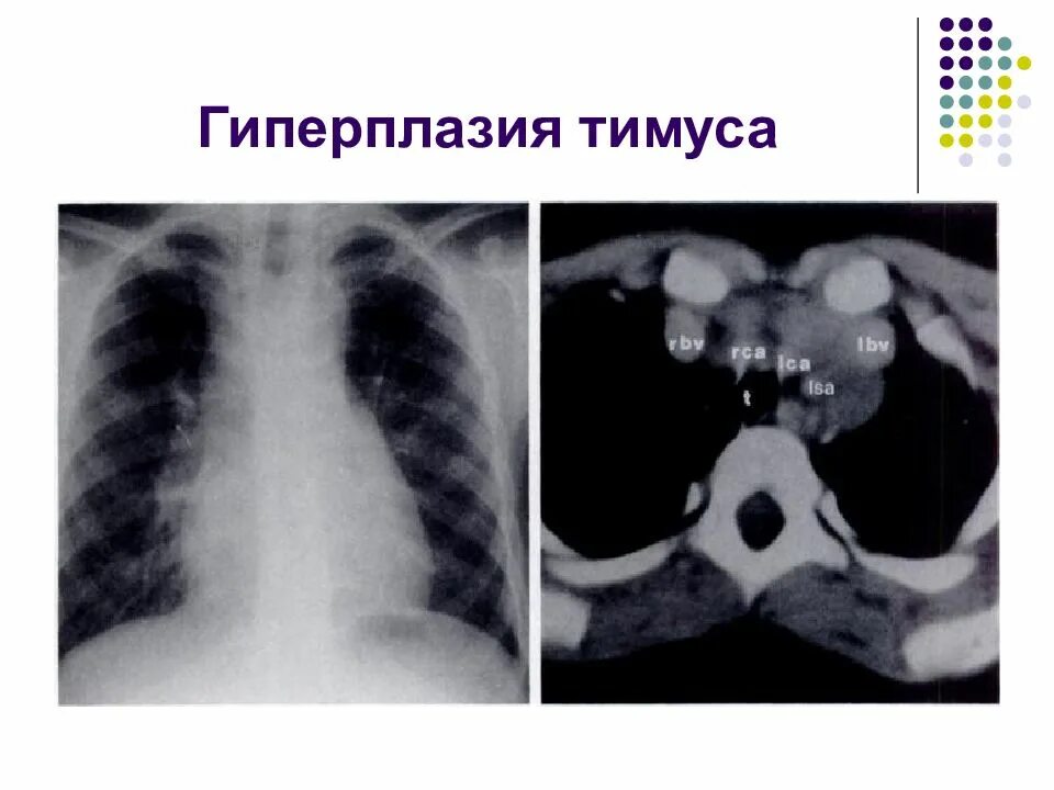 Гиперплазия лимфоузлов у детей. Гиперплазия вилочковой железы рентген. Аплазия тимуса рентген. Патологии вилочковой железы на кт.