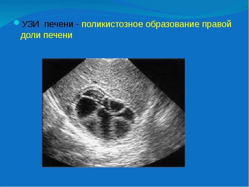 Образование в правой доле печени. Поликистозная печень УЗИ. УДЗ. Знак УДЗ.