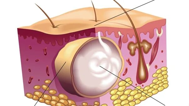 Атерома киста сальной железы. Атерома триходермальная киста. Нагноившаяся атерома лица. Капсула жировика