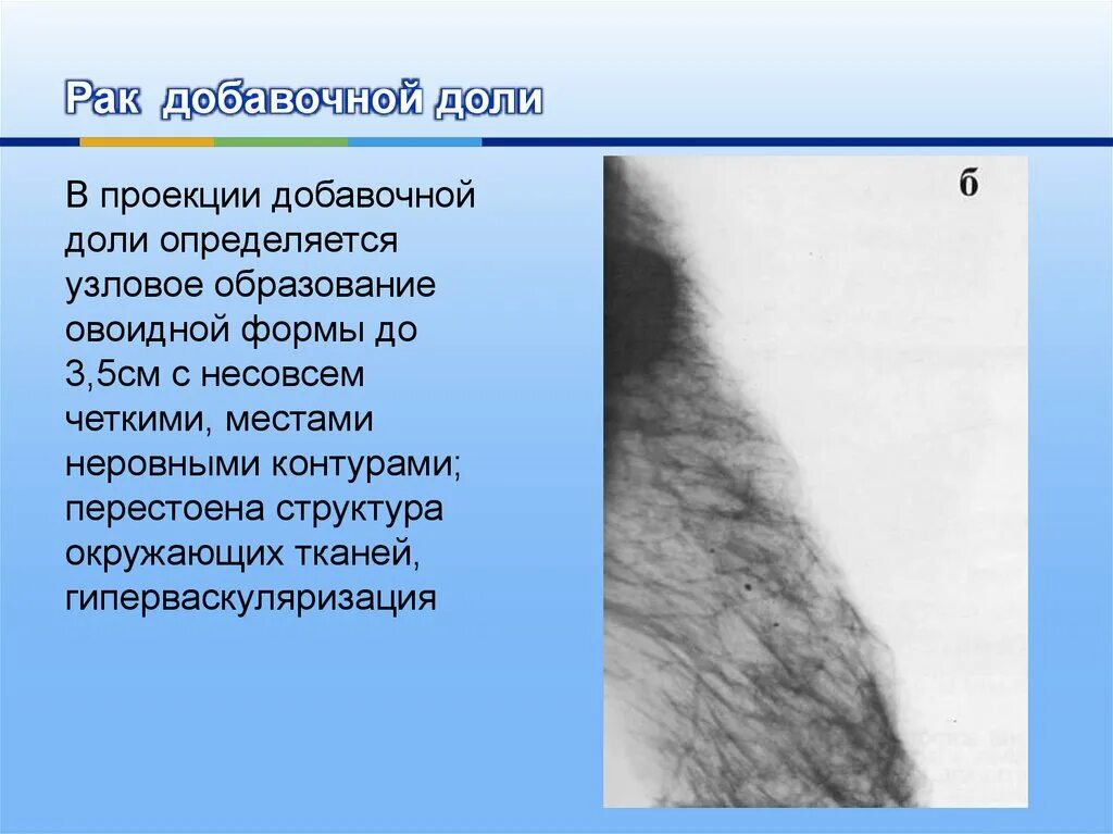 Образование молочной. Добавочная доля молочной железы. Образование с неровными контурами. Узловое образование молочной железы с четкими неровными контурами. Добавочная долька молочной железы на маммографии.