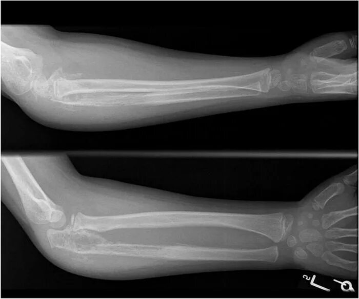 This is what happens to your ulna and radius when you turn your wrist (supinatio