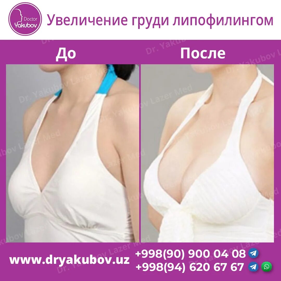 Когда можно заниматься после маммопластики