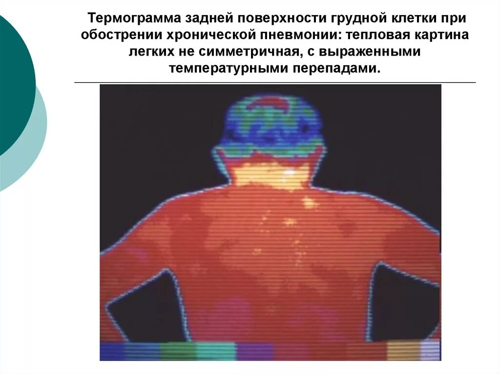 Крупозная пневмония боль в грудной клетке. Боль в грудной клетке при очаговой пневмонии. Одышка алгоритм диагностики. Боли в грудной клетке после пневмонии. Форма грудной клетки при бронхиальной астме.