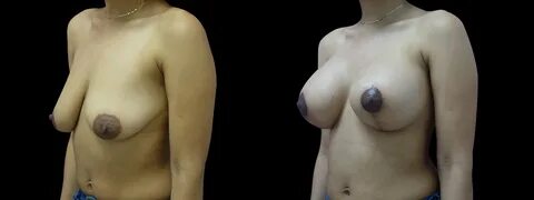 Procedure: Breast Lift and Augmentation with 375 CC silicone gel implants, ...