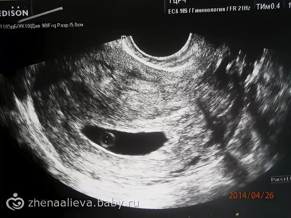 узи замершая беременность 5 недель. 1 мм анэмбриония. замерзшая беременность 10 недель. узи замершей беременности 4 недели. узи 4-6 недель беременности.