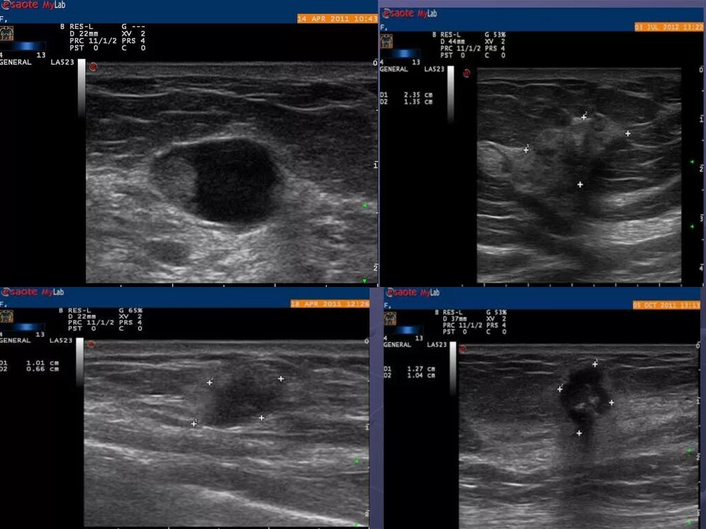 Записаться на узи молочной железы. Допплерография грудных желез. Клинический случай ультразвуковая диагностика. Как делают УЗИ груди. Как делают УЗИ груди у женщин.