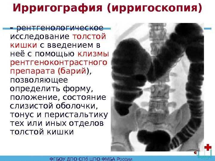 Исследование прямой и сигмовидной кишки. Рентгеноконтрастное исследование толстой кишки. Рентгенологическое исследование толстой кишки (ирригоскопия). Рентгенологическое исследование Толстого кишечника (ирригоскопия).. Синдром раздраженного кишечника рентег.