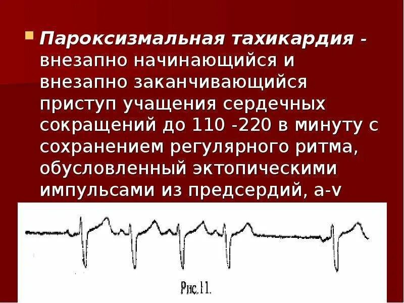 Тахикардия повышение ад. Пароксизмальная тахикардия экг. пароксизм синусовой тахикардии. пароксизмальная синусовая тахикардия. пароксизмы эктопической тахикардии.