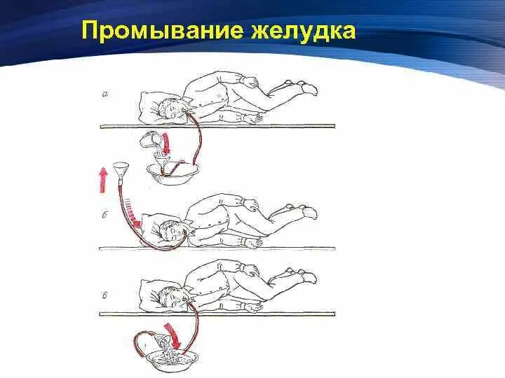 При отсутствии сознания допускается ли промывать желудок
