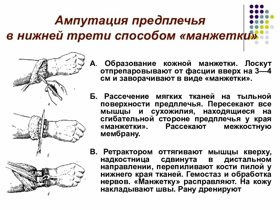 Операции верхних конечностей. Ампутация верхней конечности на уровне ср/3 предплечья. Ампутация предплечья в нижней трети. Двухлоскутная ампутация предплечья. Ампутация с Выкраиванием Лоскутов в виде манжетки предплечья.