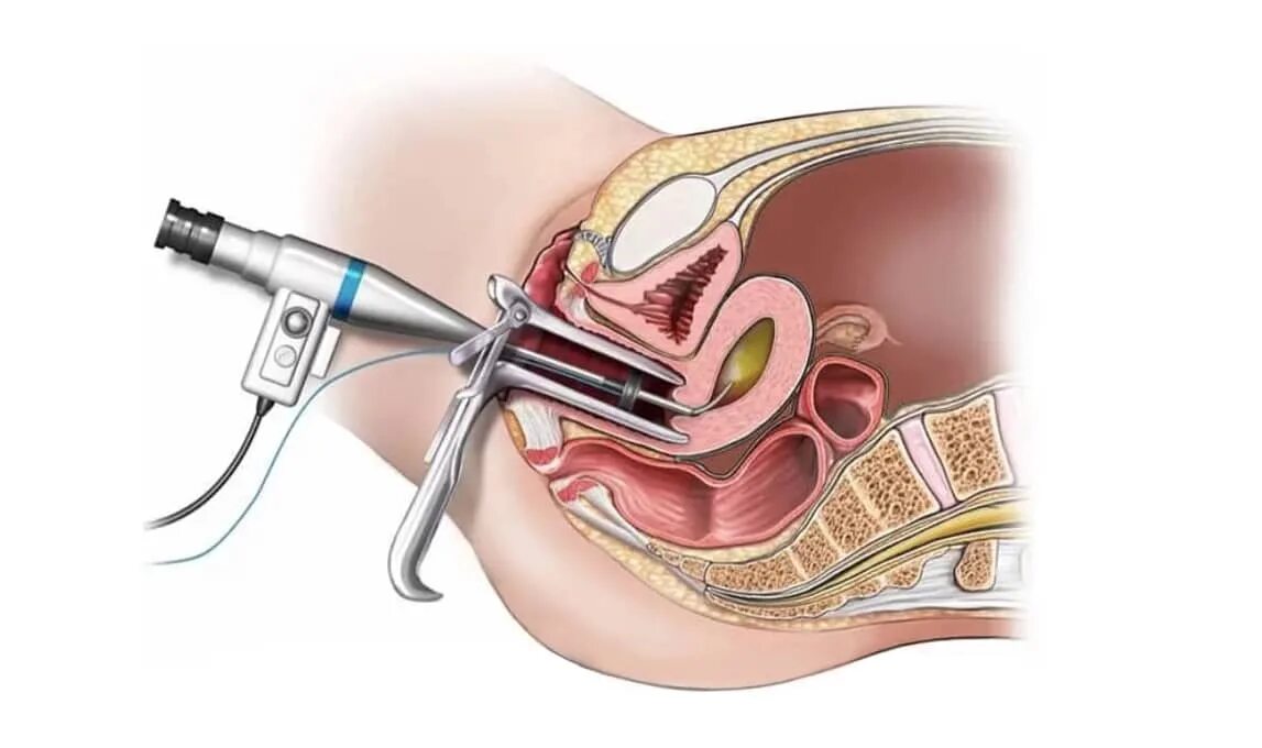 Выскабливание узи. Диагностическое выскабливание полости матки. Гистерорезектоскопия (резектоскопия). Диагностическое выскабливание цервикального канала. Выскабливание цервикального канала шейки.