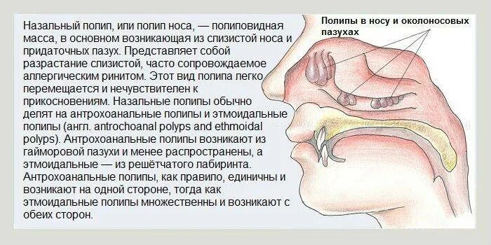 Сопли нет обоняния
