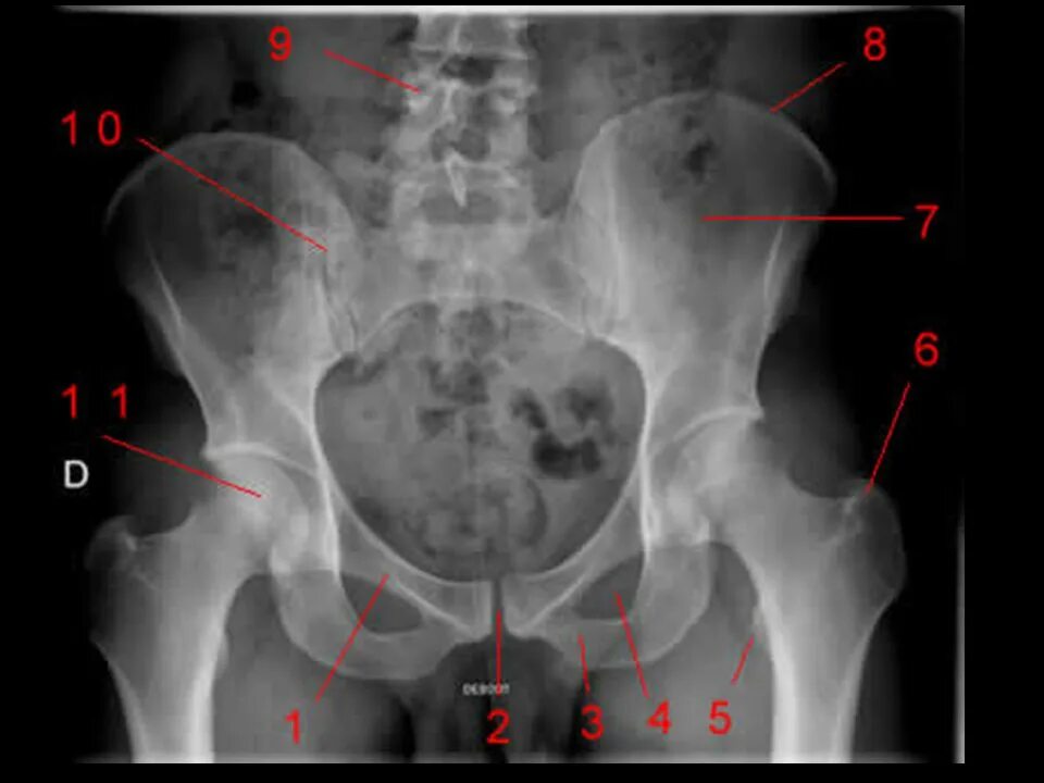 Подвздошной кости 2. Анатомия подвздошной кости рентген. Метастазы в тазобедренном суставе рентген. Остеопороз костей таза рентген. Тазобедренный сустав рентген анатомия.