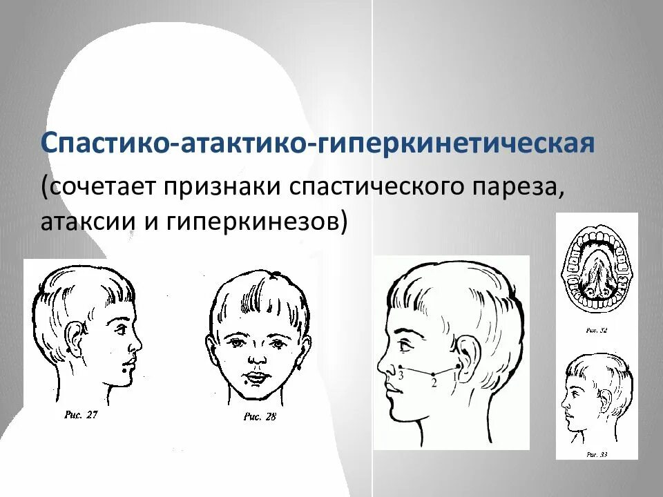 Спастико-гиперкинетическая форма ДЦП. Гиперкинетическая форма дизартрии. Атактико-гиперкинетическая дизартрия форма ДЦП У детей. Спастико паретическая дизартрия