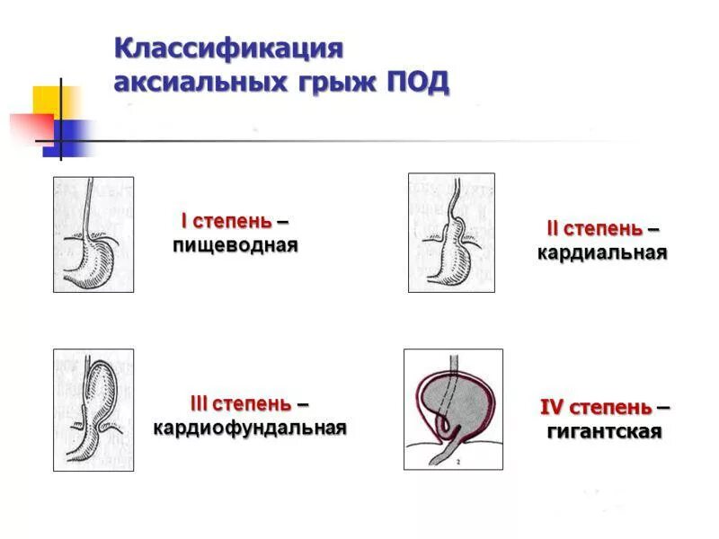 Грыжа пищевода показать. Классификация грыж пищеводного отверстия диафрагмы стадии. Грыжа пищеводного отдела диафрагмы классификация. Аксиальные грыжи пищеводного отверстия диафрагмы классификация. Грыжа пищевого отдела диафрагмы 2 степени.