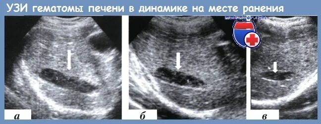 Контроль лечения в послеоперационном периоде ранений - выявление осложнений