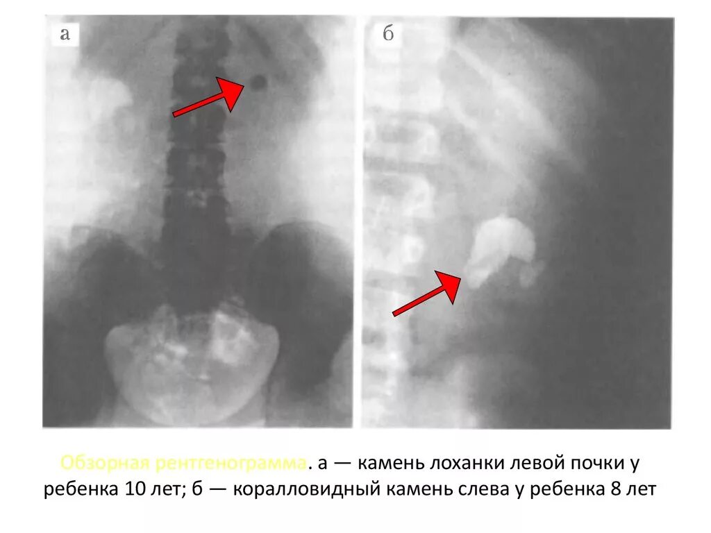 Обзорная рентгенография почек коралловидный камень. Коралловидный камень в почке рентген. Камни в лоханке почки рентген. Коралловидный камень лоханки рентгенограмма.