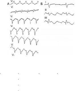 Тахикардия qrs