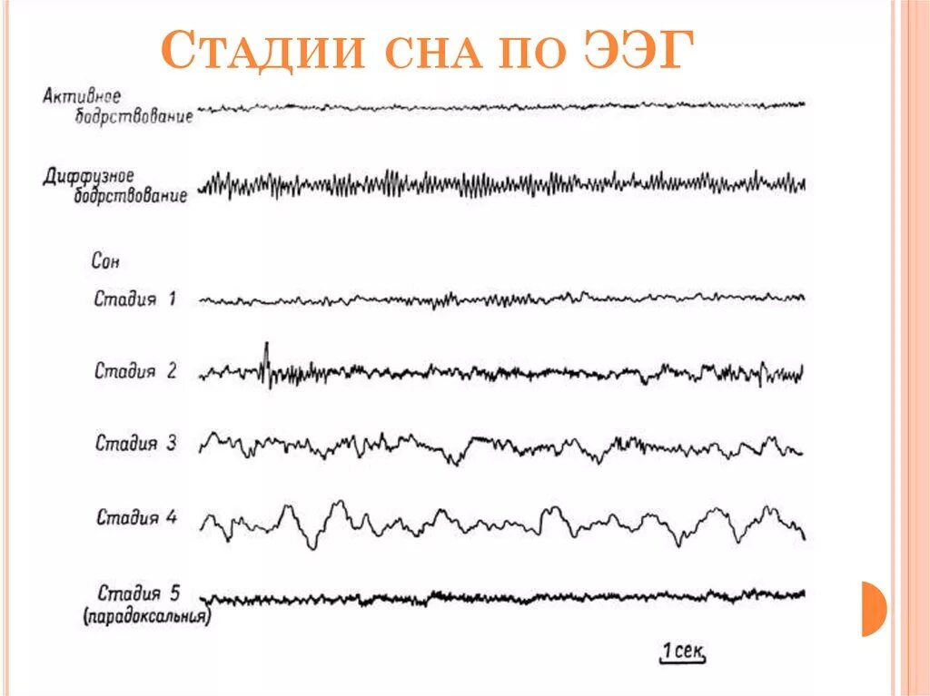 Фаза быстрого сна ЭЭГ. Фазы медленного сна ЭЭГ. Стадии сна на ЭЭГ. Фазы сна показатели ЭЭГ. Сон диффузный