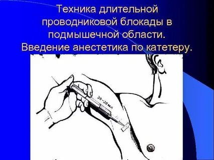 Анестезия конечностей