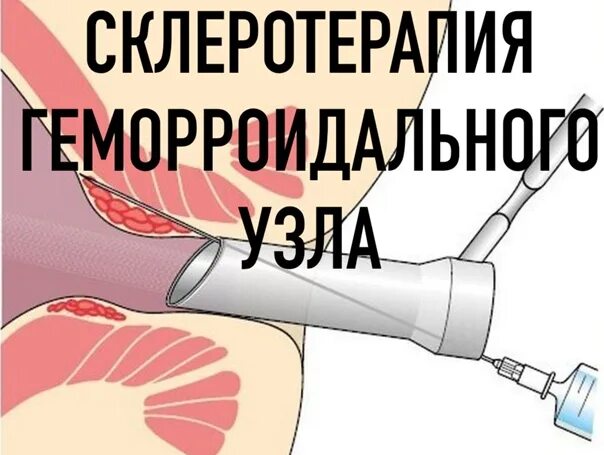 Склеротерапия варикозно расширенных вен пищевода. Склерозирование узлов. Склеротерапия при геморрое. Склеротерапия внутренних геморроидальных узлов. Склеротерапия геморроидальных узлов.