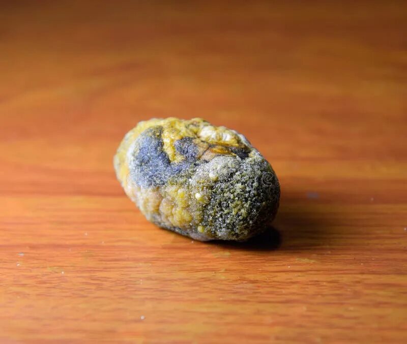 Пигментные камни в желчном пузыре. Пигментные камни желч пузыря. Маленькие камни в желчном пузыре.